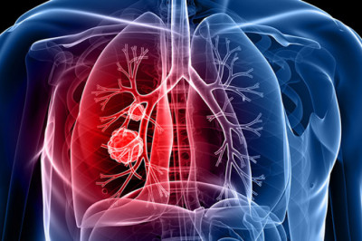 Asia-Pacific Non-Small Cell Lung Cancer Diagnostics Market Rising Trends, Industry Analysis and Demands 2021 to 2028