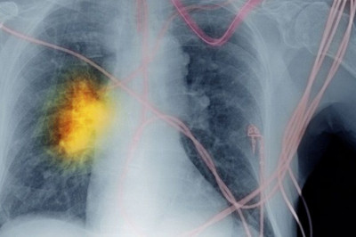Europe Non-Small Cell Lung Cancer Diagnostics Market to Experience Significant Growth during the Forecast Period 2021-2028