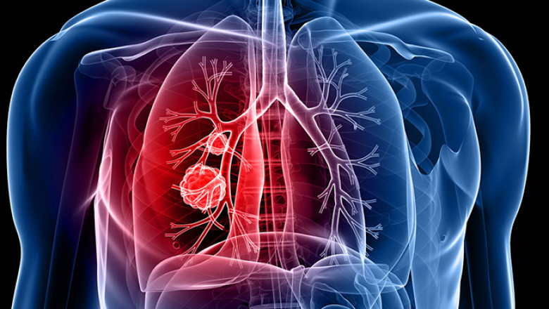 Middle East And Africa Non-Small Cell Lung Cancer Diagnostics Market 2021 Sales Revenue, Opportunity Analysis, Comprehensive Analysis and Landscape Outlook to 2028