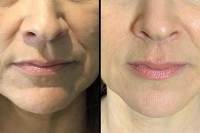 What Impacted COVID-19 on Dermal Fillers ?