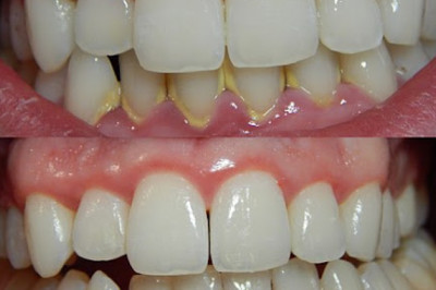 Significant COVID-19 Impact on Periodontitis in the Healthcare Industry