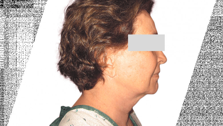 Complications And Recovery From A Neck Liposuction