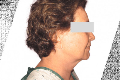 Complications And Recovery From A Neck Liposuction