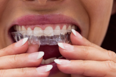 Invisalign Treatment Process – The 5 Stages