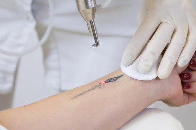 Global Tattoo Removal Market Report Available on Introspective Market Research