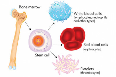 What Are The Complications of a Bone Marrow Transplantation?