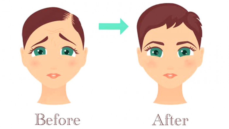 Who is the Right Candidate of PRP Treatment?