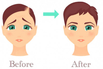 Who is the Right Candidate of PRP Treatment?