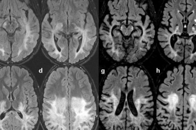 Cerebral Adrenoleukodystrophy Treatment Market 2021 Growth, Latest Trend Analysis and Forecast 2028