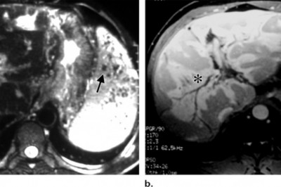 Periportal Fibrosis Market 2021 Future Trend, Growth rate, Opportunity, Industry Analysis to 2028