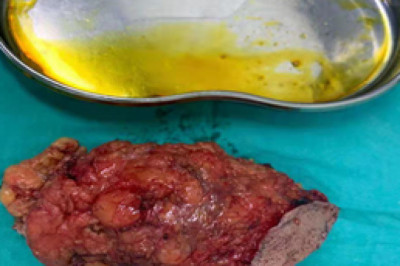 Clinics of Surgery | Surgery Journal | Open Access Journal