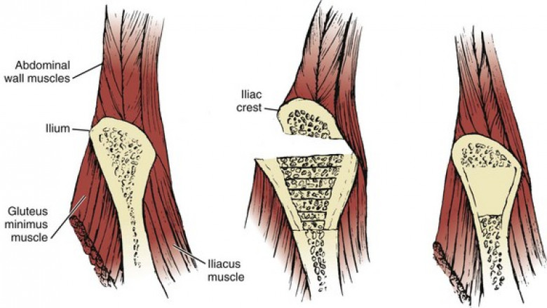 Four Simple Steps for Autograft Bone Harvesting