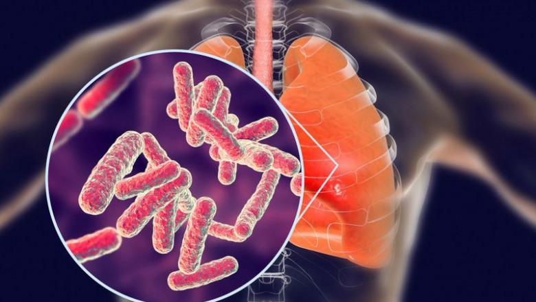 How Tuberculosis Drugs Spreads