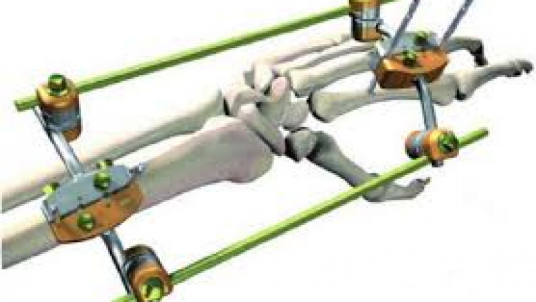 Trauma Fixation Device Market Trend 2021, Analysis, Growth Drivers and Share Forecast to 2026