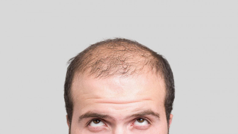 Regular Remedies To Stop Hair Fall