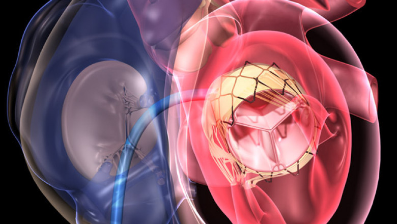 Transcatheter Pulmonary Valve Market 2021 Key Drivers and Restraints, Regional Outlook, End-User Applicants by 2028