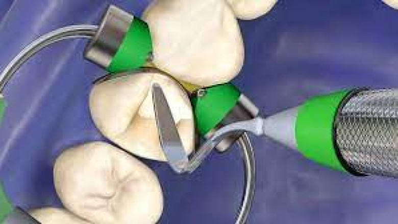 Direct Restorative Materials of Dental Consumables Market Industry Analysis by Size, Recent Trends Forecast to 2026