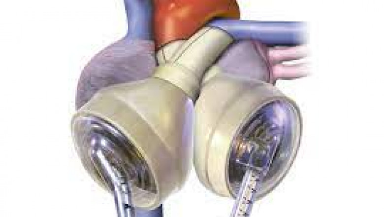 Total Artificial Heart Market Indications and Surgical Assessments, Trends and Key Players- BiVACOR, SynCardia, Jarvik Heart