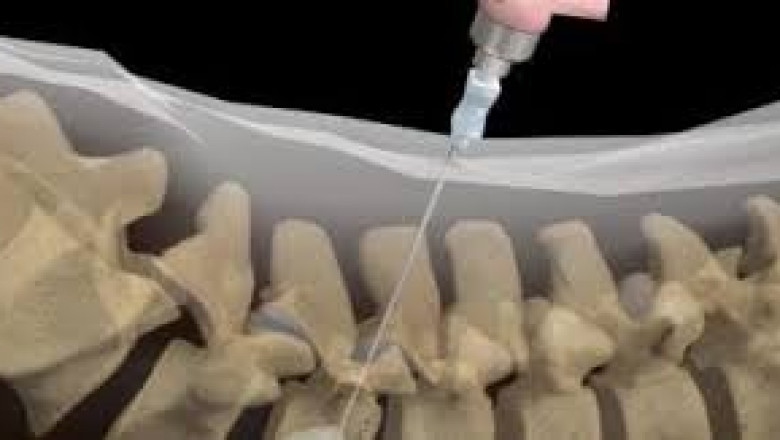 Vertebroplasty and Kyphoplasty Devices Market Surgical Technique and Clinical Outcomes, Comparative Analysis 2021 to 2026