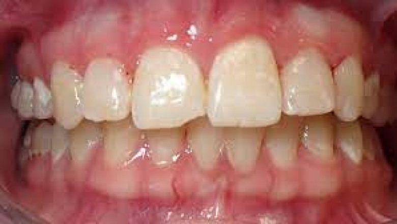 Dentures in Medford Oregon