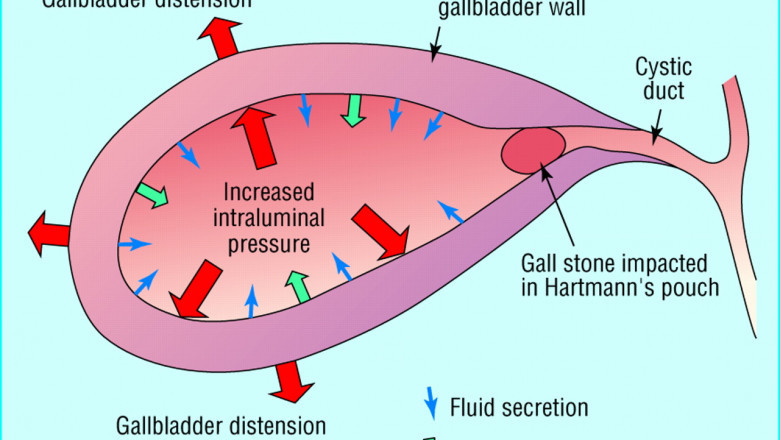 Acute cholecystitis Market 2021 - Business Strategies, Product Sales and Growth Rate, Assessment to 2028