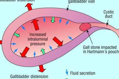 Acute cholecystitis Market 2021 - Business Strategies, Product Sales and Growth Rate, Assessment to 2028