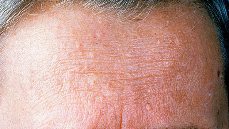 Cowden's Disease Treatment Market to Experience Significant Growth during the Forecast Period 2021-2028