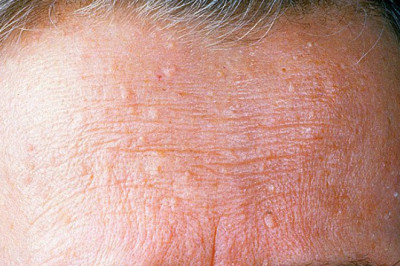 Cowden's Disease Treatment Market to Experience Significant Growth during the Forecast Period 2021-2028