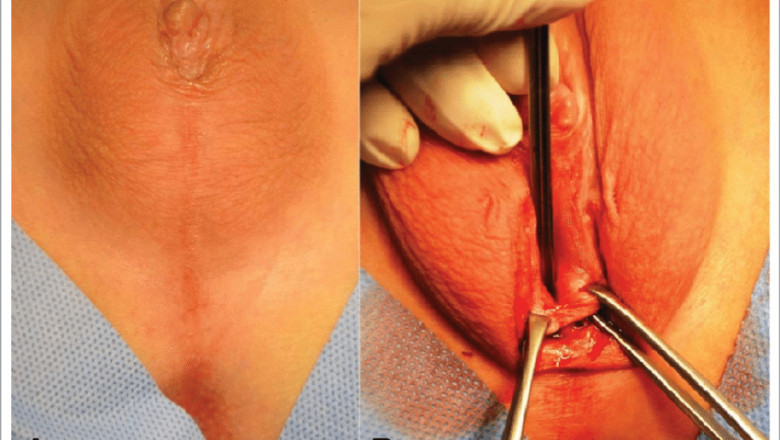 Partial Androgen Insensitivity Syndrome Market 2021 - Business Strategies, Product Sales and Growth Rate, Assessment to 2028