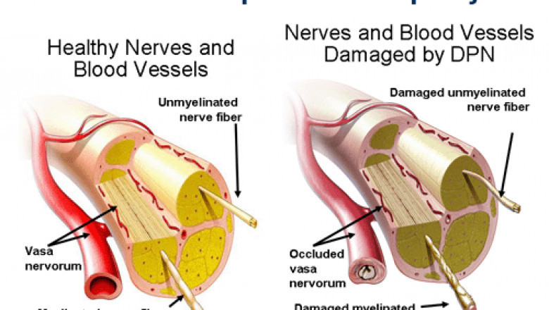 Diabetic Peripheral Neuropathy Medications