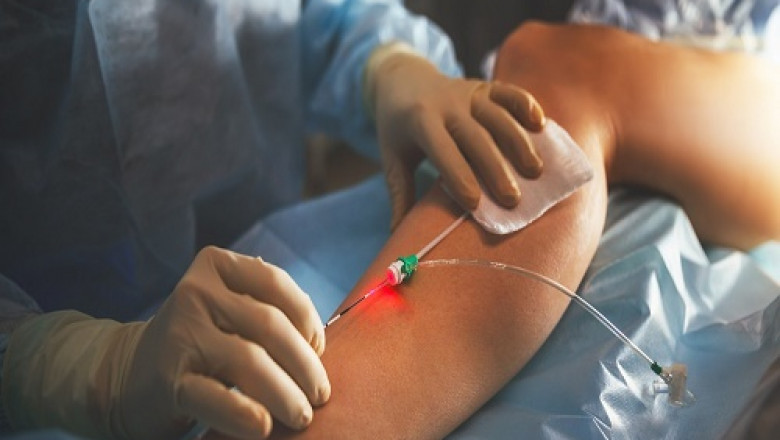 Types of Laser Vein Treatment