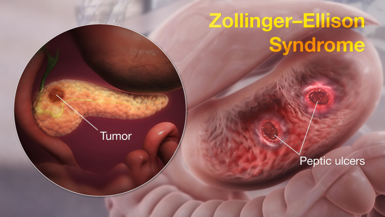 Zollinger-Ellison Syndrome Treatment Market 2022 Top Manufactures, Growth Opportunities and Investment Feasibility 2028