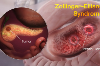 Zollinger-Ellison Syndrome Treatment  Market 2022 Top Manufactures, Growth Opportunities and Investment Feasibility 2028