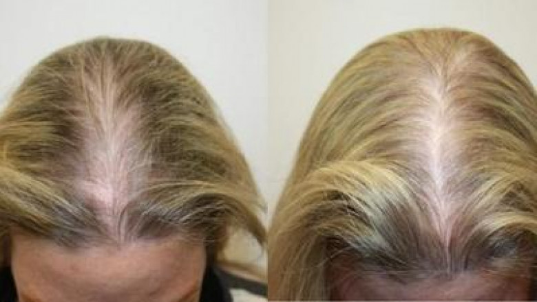 Benefits of Laser Hair Therapy