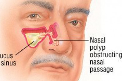 Global Nasal Polyps Treatment Market Report 2021: A $4,243.9 Million Market by 2030