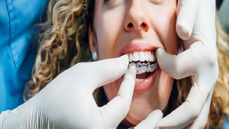 Invisible Braces Price in India | Guidelign.com