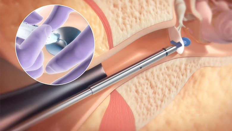 Ear Tube Devices Market 2022 Comprehensive Analysis, Business Growing Strategies, Industry Segmentation and Forecast 2029