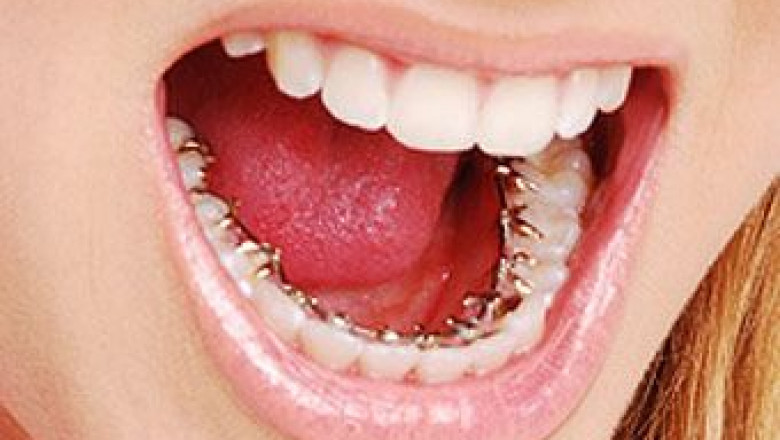 How Do Lingual Braces Work?