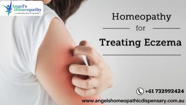Homeopathic Medicines for Eczema