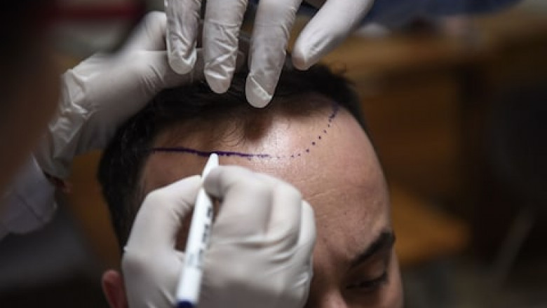 Provisions to take After Hair Restoration in winters