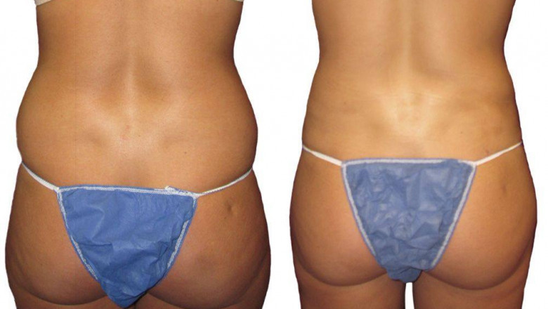 Butt Surgery Could Be The One You Are Looking For