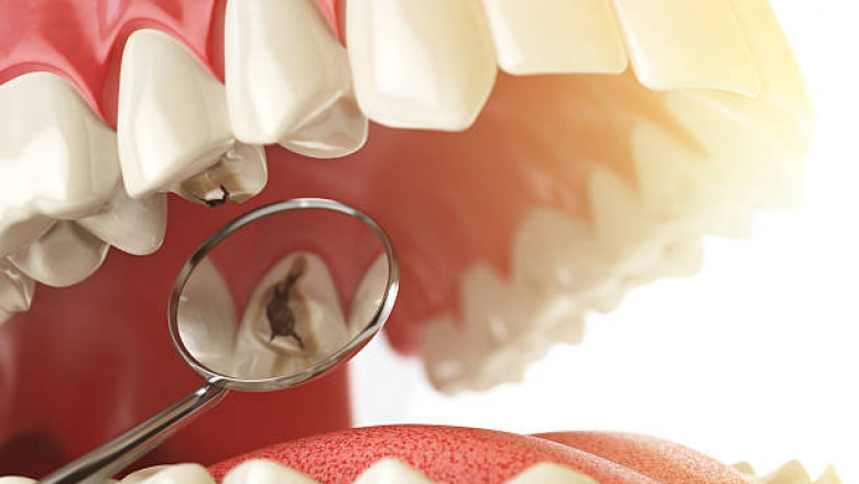 Dental Caries Bacteria in Primary and Permanent Teeth of Children and Young Adults