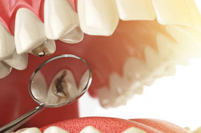 Dental Caries Bacteria in Primary and Permanent Teeth of Children and Young Adults