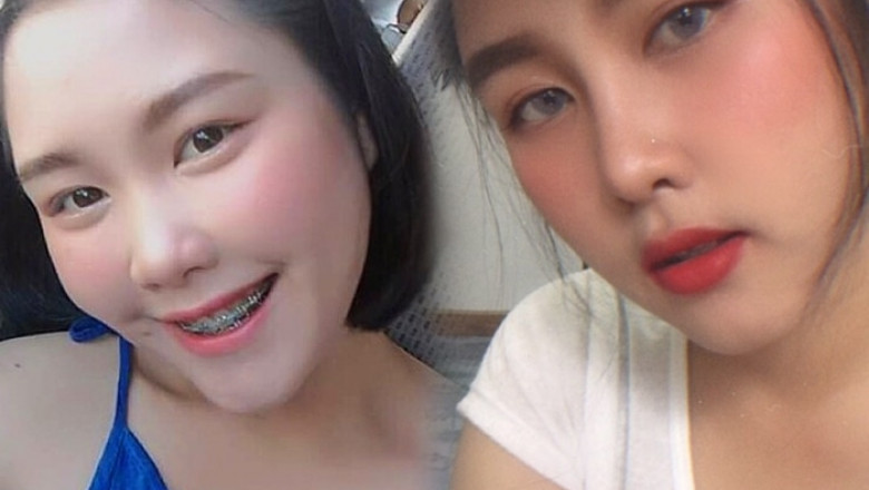 Rhinoplasty: What You will need to know