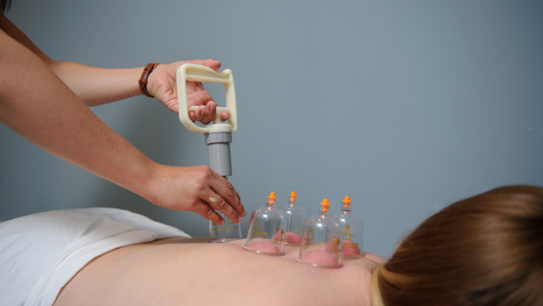 Cupping Therapy Guelph | Naturalchoicemedicalclinic.com