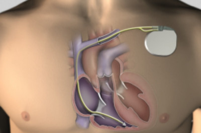 Pacemakers and Cardiac Resynchronization Therapy Devices Market Insights, Trends, Top Industry Players and Future Development Status by 2025 | Research Informatic