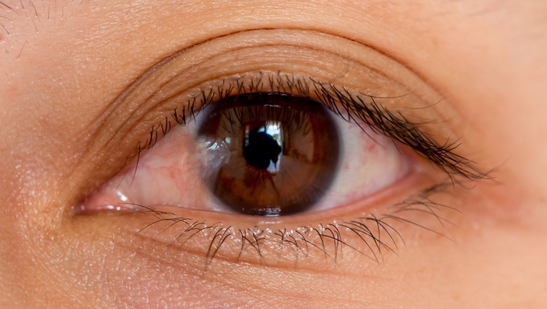 Pterygium - Causes, Symptoms, and Treatments