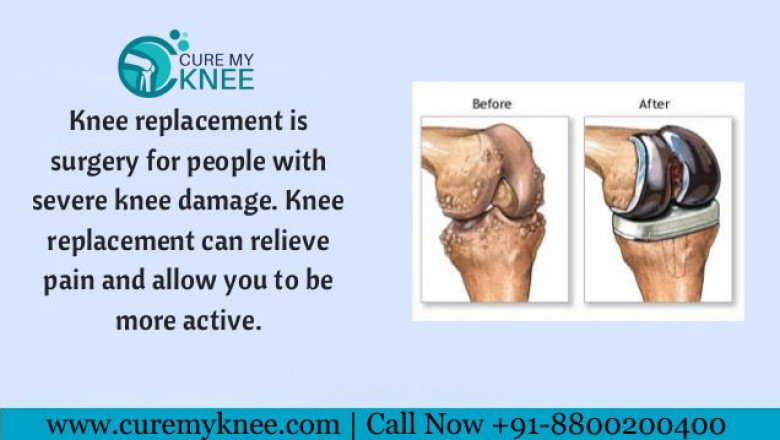 Best Knee Replacement Surgeon in Delhi