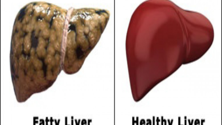 Fatty Liver: What is it and how to overcome it?