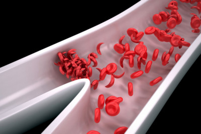 How gene therapy for Sickle Cell Anemia Therapeutics works